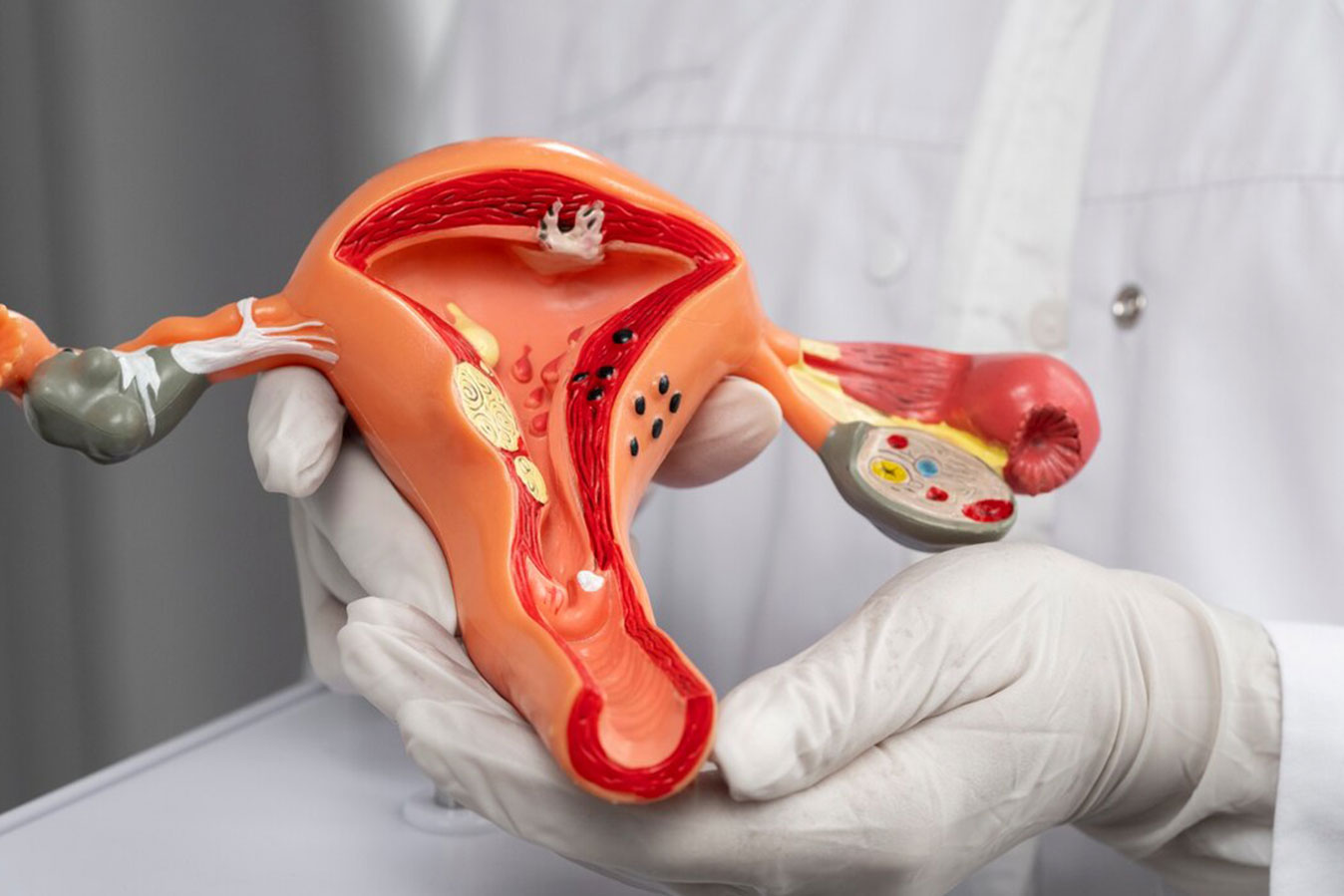 Gynecological Cancers